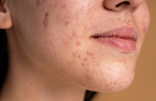 PRP therapy for hair loss at The Skin Sensé clinic