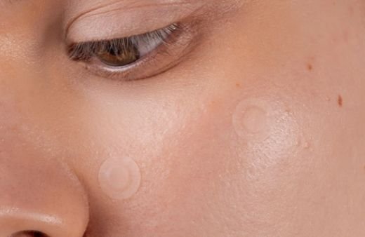 Pimple patch turning white after absorbing fluid from a whitehead