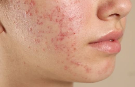 Close-up of acne breakout on the cheek that needs dermatologist treatment