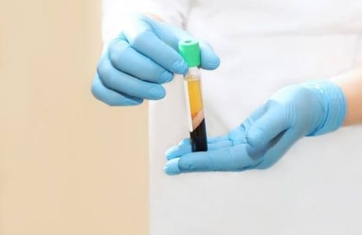 PRP tubes after centrifugation for hair loss treatment