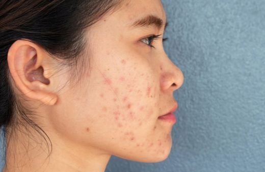 Post-acne dark spots on the cheek before treatment
