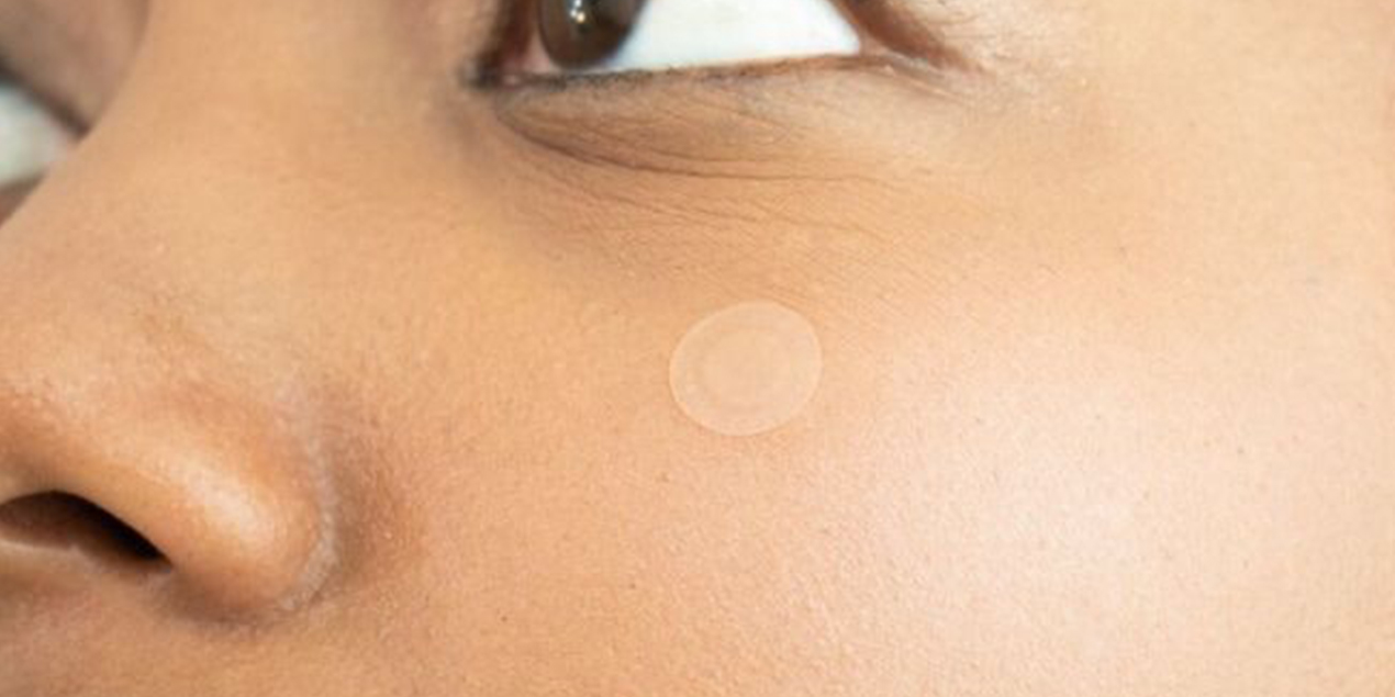 Pros & Cons of Treating Active Acne Using Pimple Patches - The Skin Sensé Blog