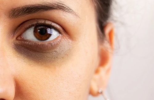 Dark Circle Treatment Results with Vitamin C