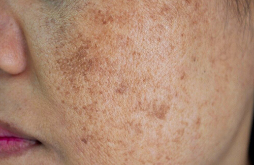 Skincare Routine for Pigmentation Treatment