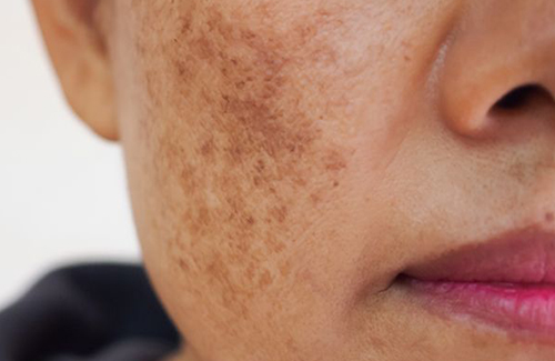 Pigmentation Before and After Treatment Results